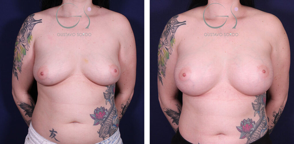Reducción de Areola: antes y después de un caso operado por el Dr. Gustavo Sordo en Madrid