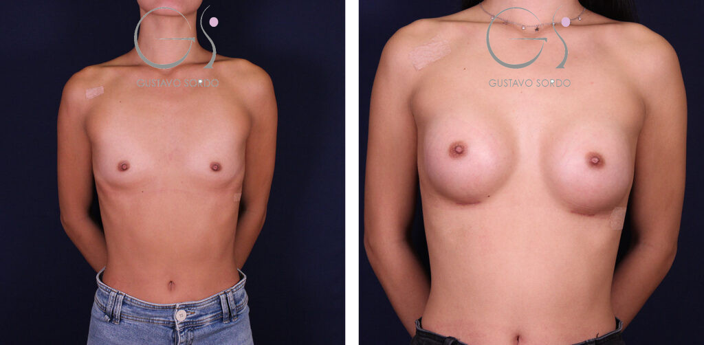 Aumento de pecho con implantes anatómicos de 260 cc en mamas separadas: antes y después