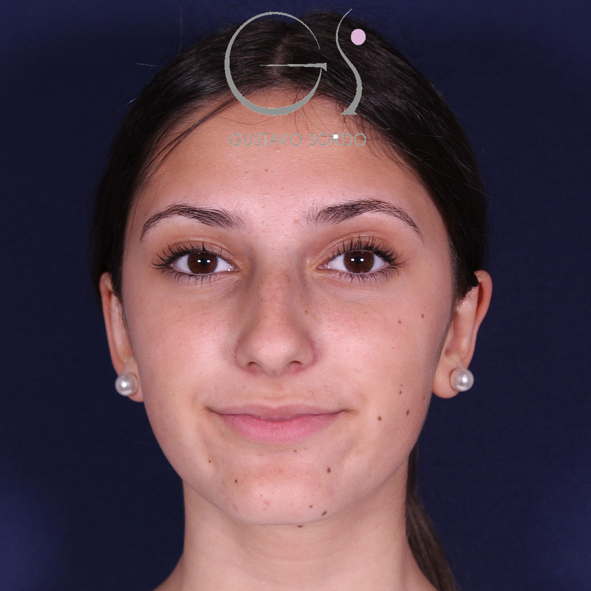 Otoplastia, después de la operación (1)