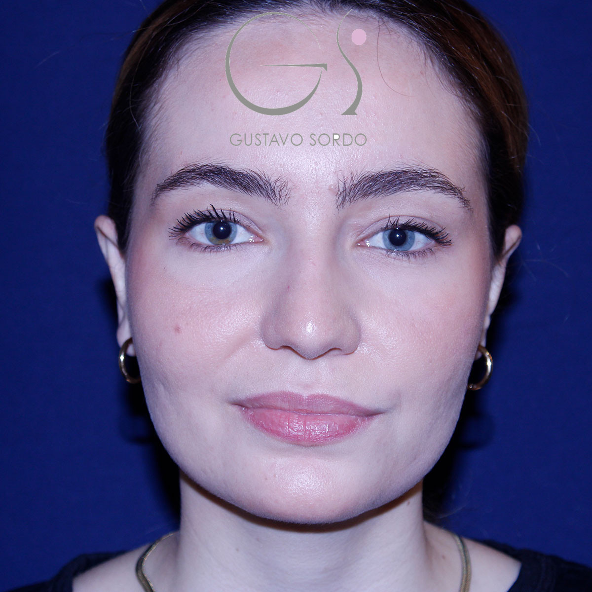 Otoplastia, después de la operación (1)