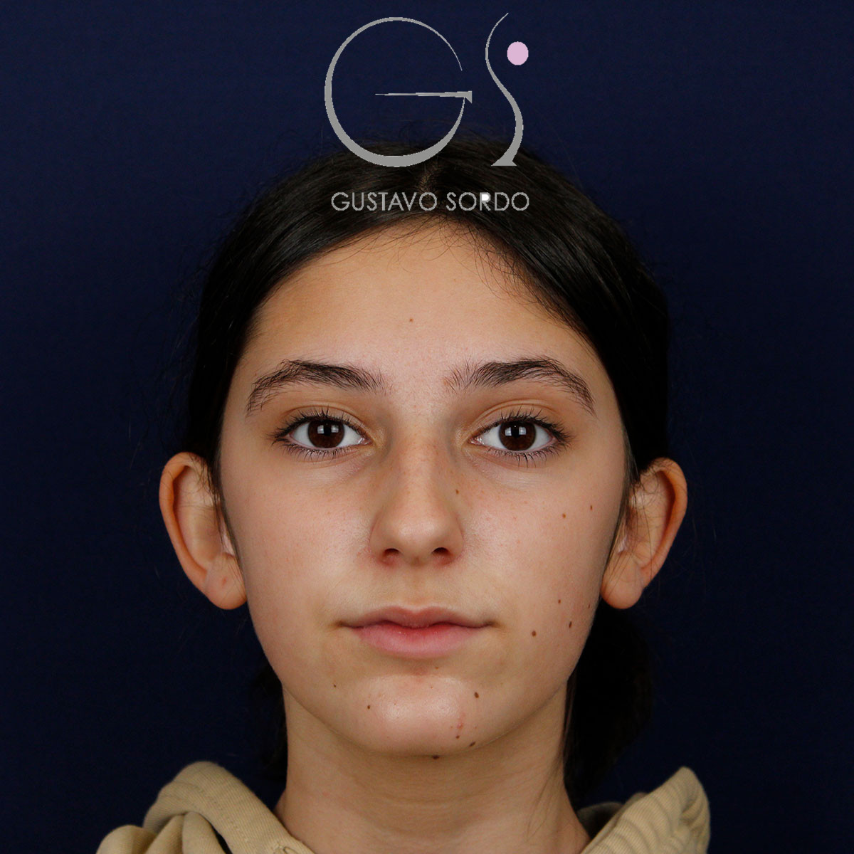 Otoplastia, antes de la operación (1)