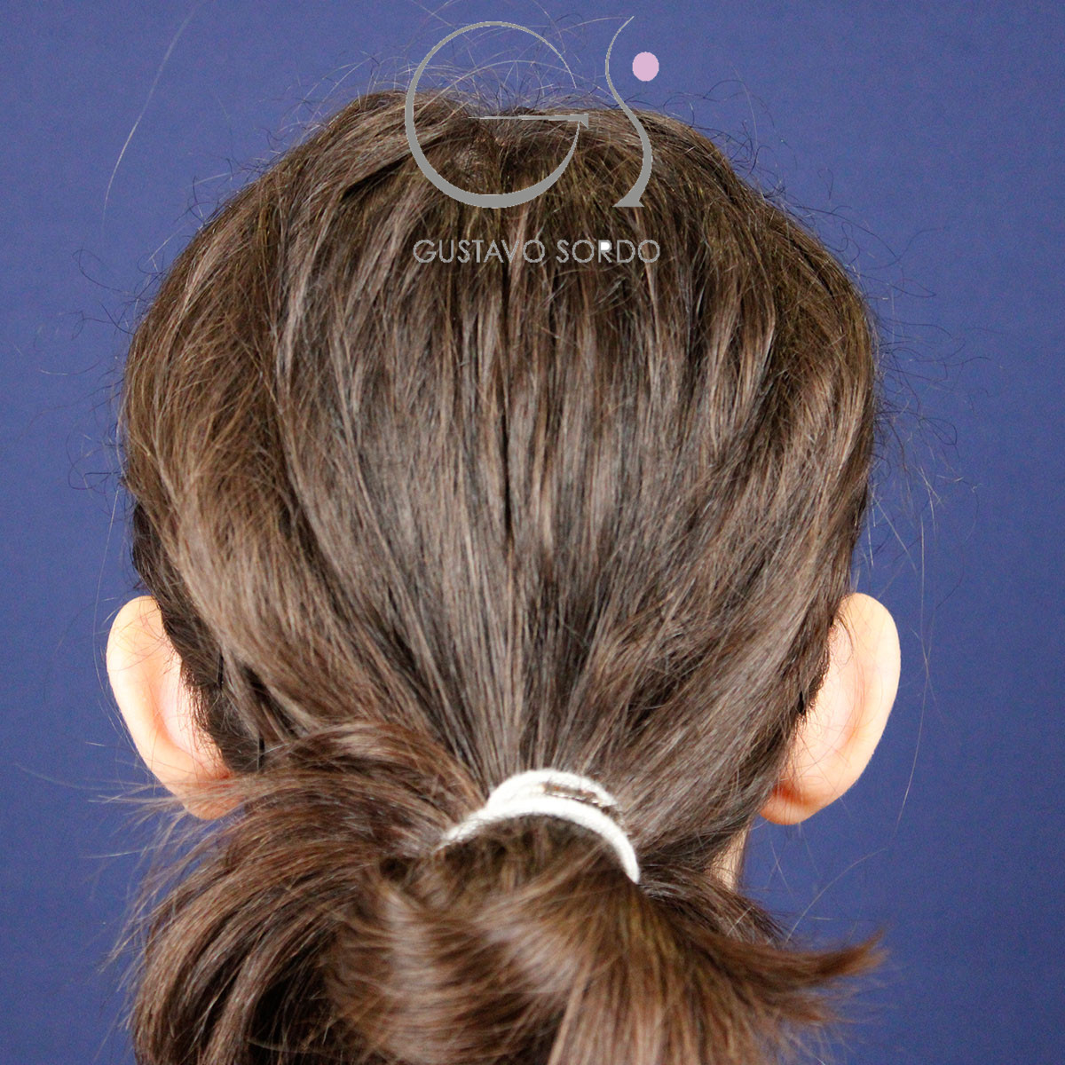 Otoplastia, antes de la operación (2)
