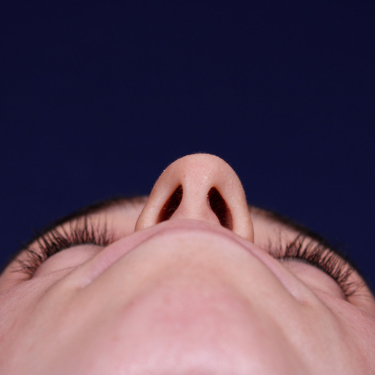 Rinoplastia ultrasónica, antes de la cirugía — caso operado por el Dr. Gustavo Sordo en Madrid (5)