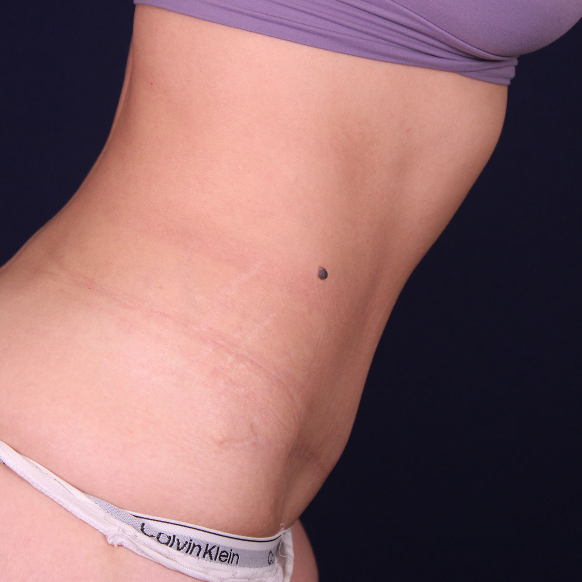 Abdominoplastia, resultado tras la cirugía — caso operado por el Dr. Gustavo Sordo en Madrid (10)