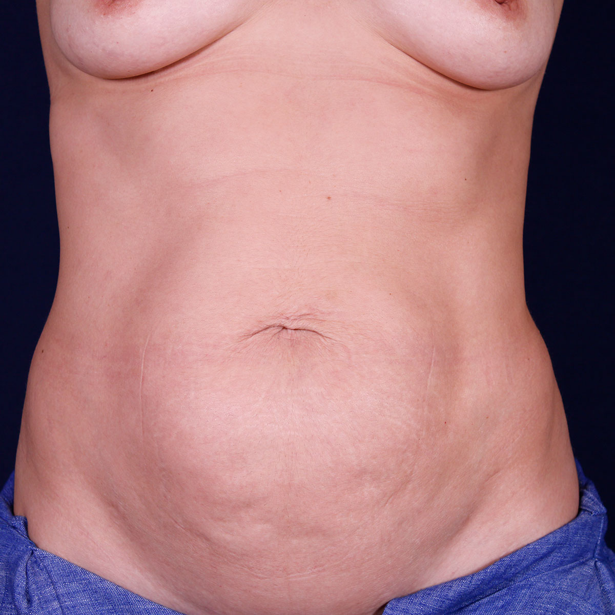 Abdominoplastia, antes de la cirugía — caso operado por el Dr. Gustavo Sordo en Madrid (1)