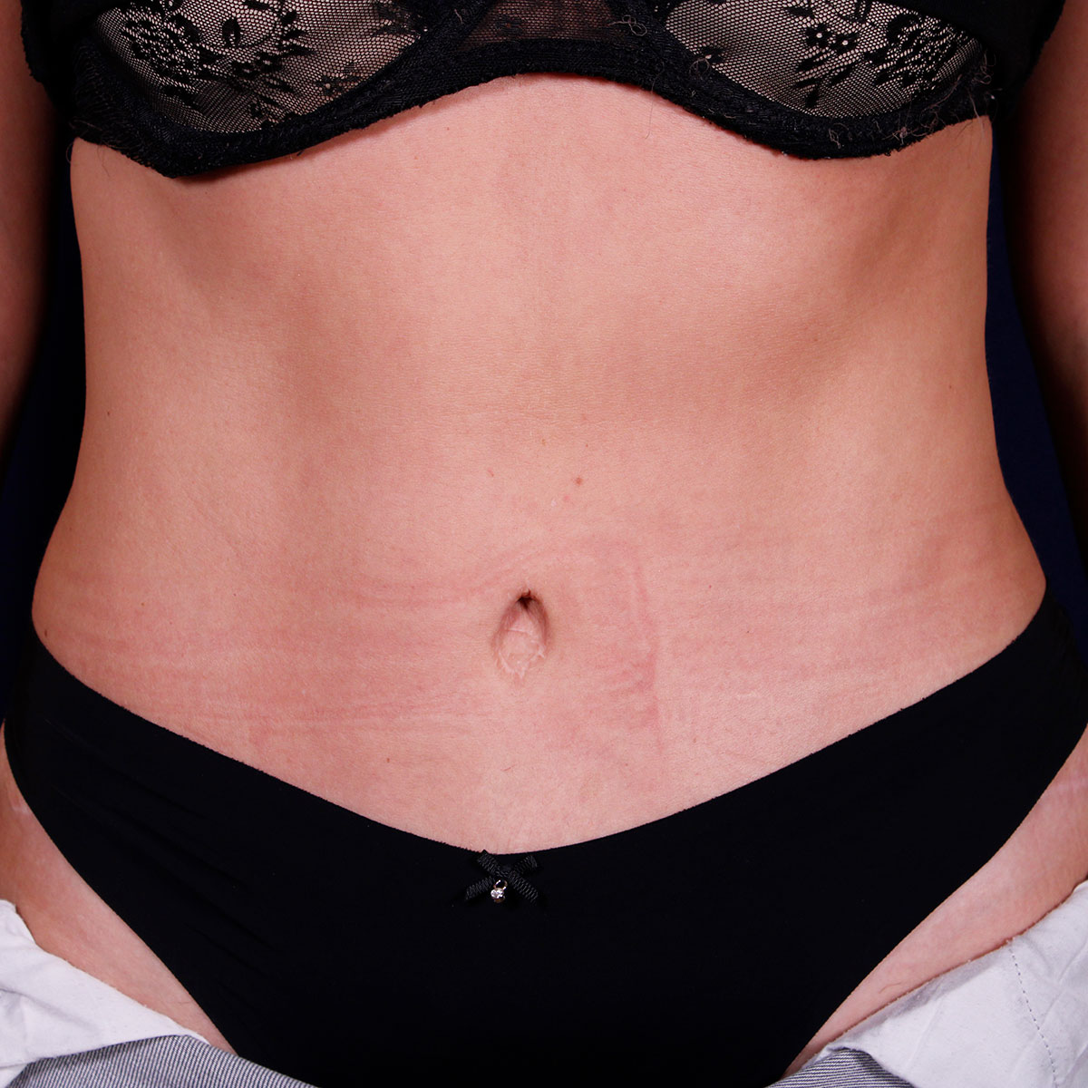 Abdominoplastia, resultado tras la cirugía — caso operado por el Dr. Gustavo Sordo en Madrid (1)