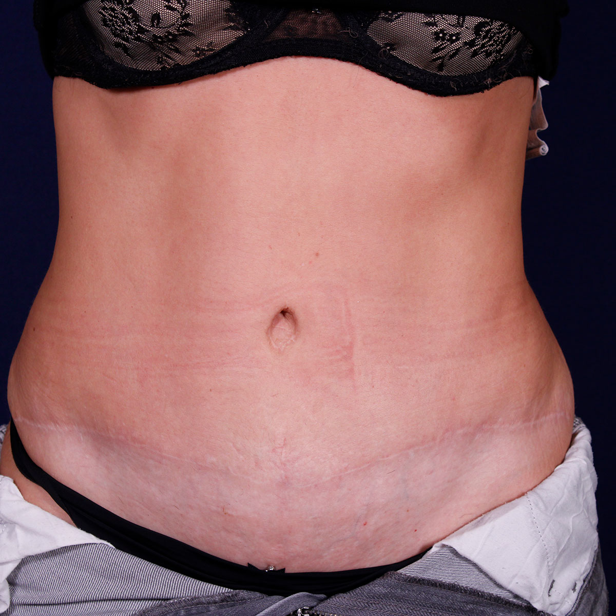 Abdominoplastia, resultado tras la cirugía — caso operado por el Dr. Gustavo Sordo en Madrid (2)