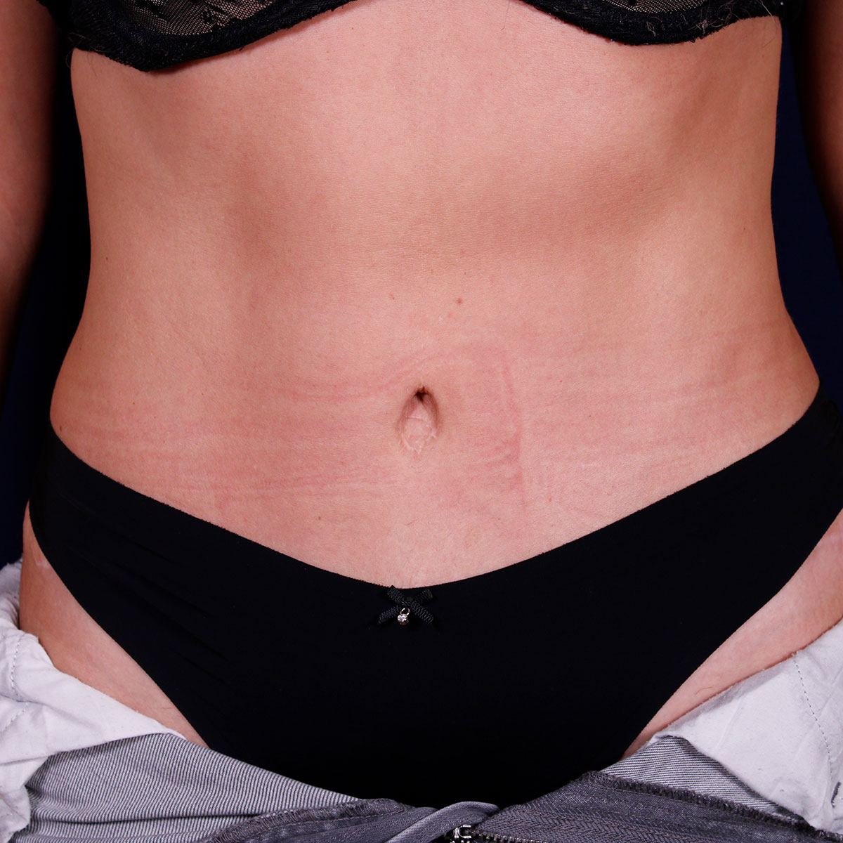 Abdominoplastia, resultado tras la cirugía — caso operado por el Dr. Gustavo Sordo en Madrid (3)
