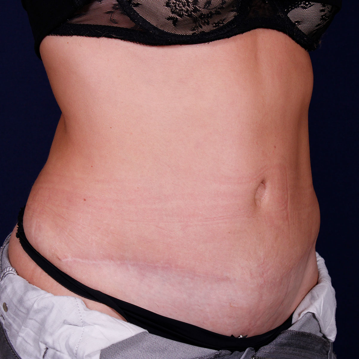 Abdominoplastia, resultado tras la cirugía — caso operado por el Dr. Gustavo Sordo en Madrid (5)