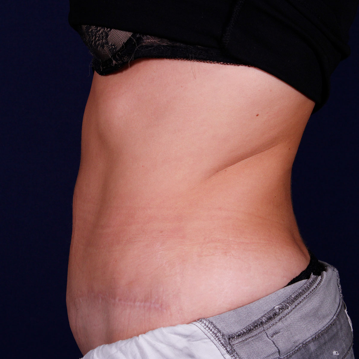 Abdominoplastia, resultado tras la cirugía — caso operado por el Dr. Gustavo Sordo en Madrid (6)