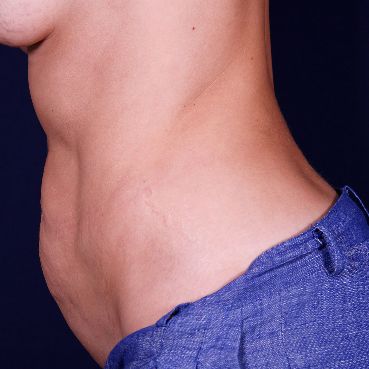 Abdominoplastia, antes de la cirugía — caso operado por el Dr. Gustavo Sordo en Madrid (7)