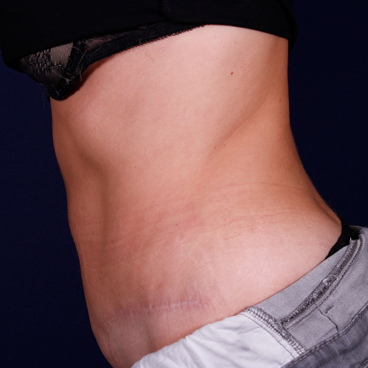 Abdominoplastia, resultado tras la cirugía — caso operado por el Dr. Gustavo Sordo en Madrid (7)
