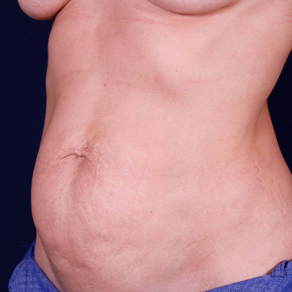 Abdominoplastia, antes de la cirugía — caso operado por el Dr. Gustavo Sordo en Madrid (8)