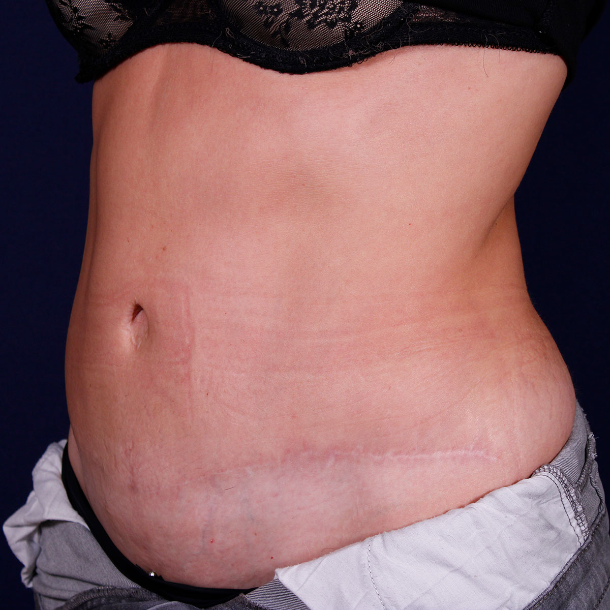 Abdominoplastia, resultado tras la cirugía — caso operado por el Dr. Gustavo Sordo en Madrid (8)