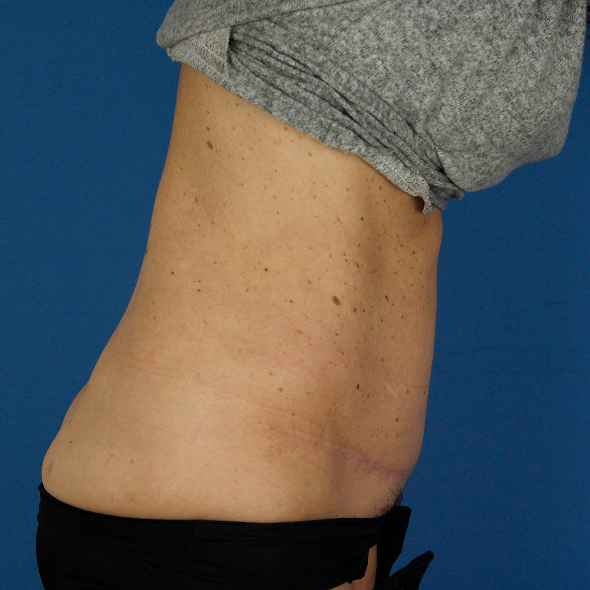 Abdominoplastia, resultado tras la cirugía — caso operado por el Dr. Gustavo Sordo en Madrid (1)