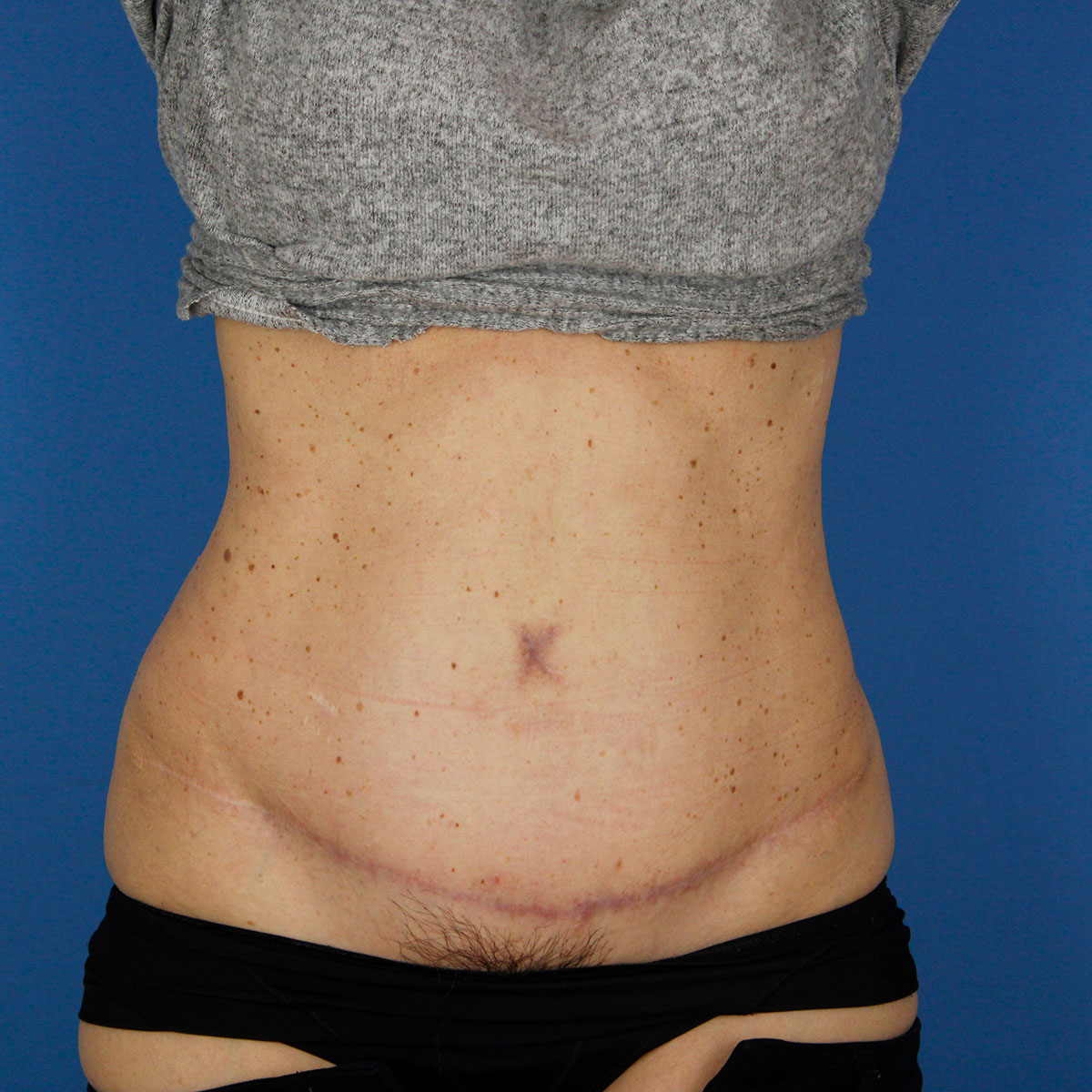 Abdominoplastia, resultado tras la cirugía — caso operado por el Dr. Gustavo Sordo en Madrid (2)