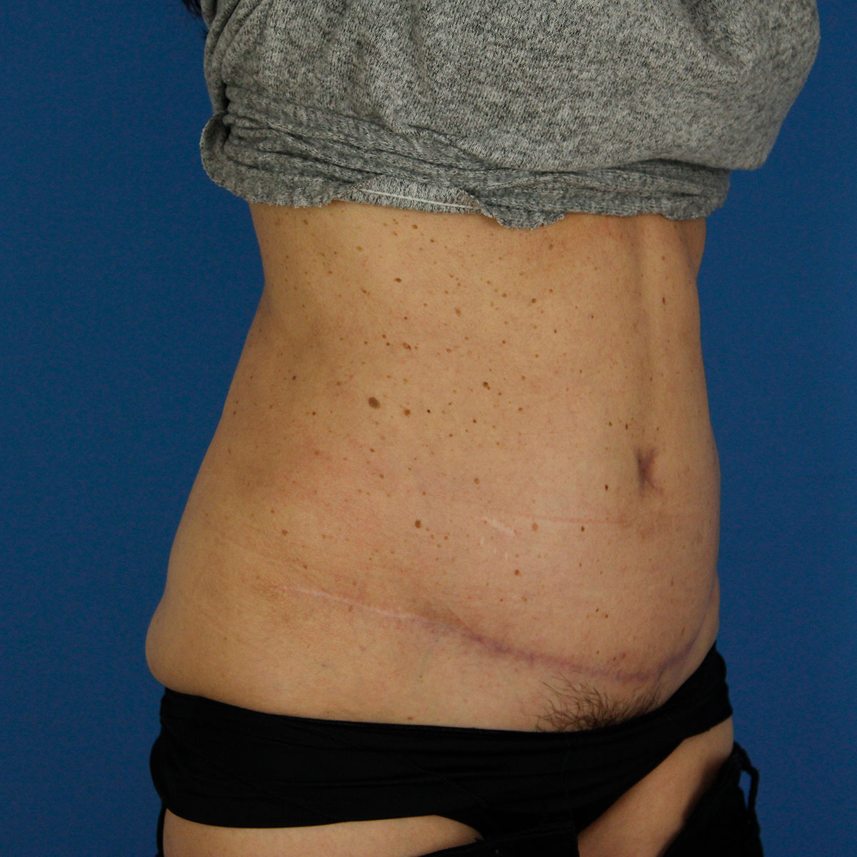 Abdominoplastia, resultado tras la cirugía — caso operado por el Dr. Gustavo Sordo en Madrid (3)