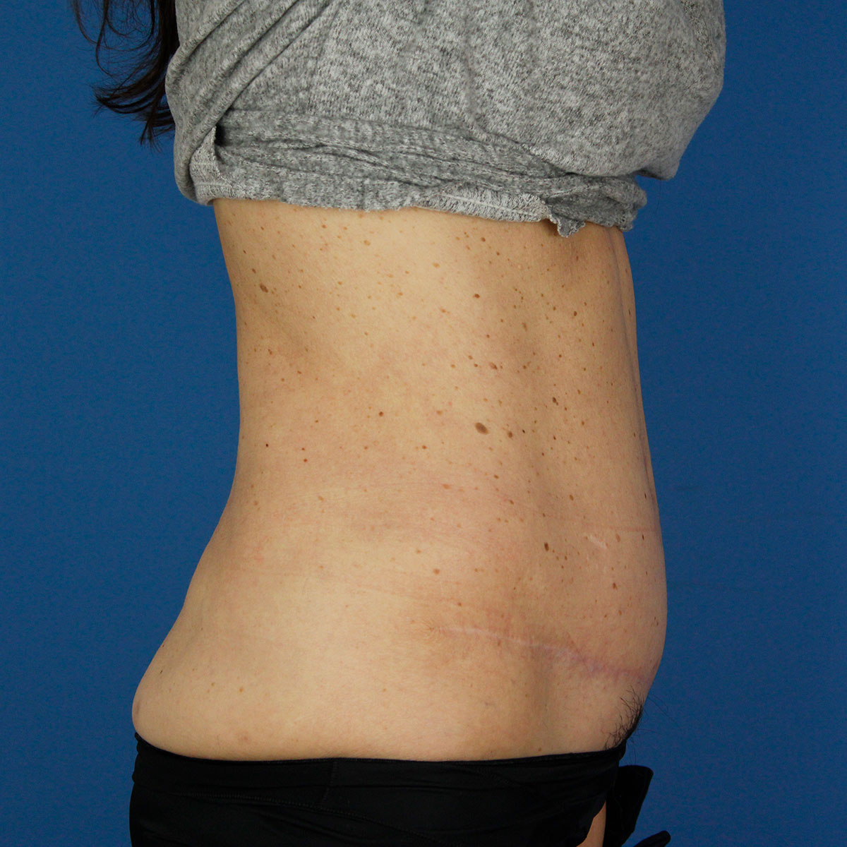 Abdominoplastia, resultado tras la cirugía — caso operado por el Dr. Gustavo Sordo en Madrid (4)