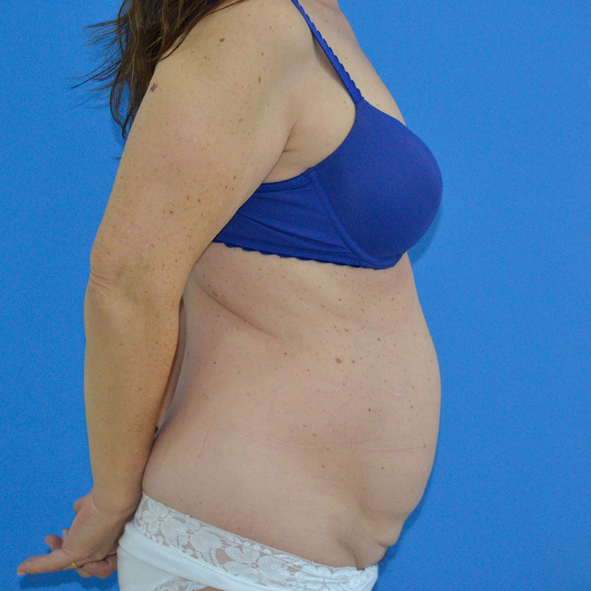 Abdominoplastia, antes de la cirugía — caso operado por el Dr. Gustavo Sordo en Madrid (5)