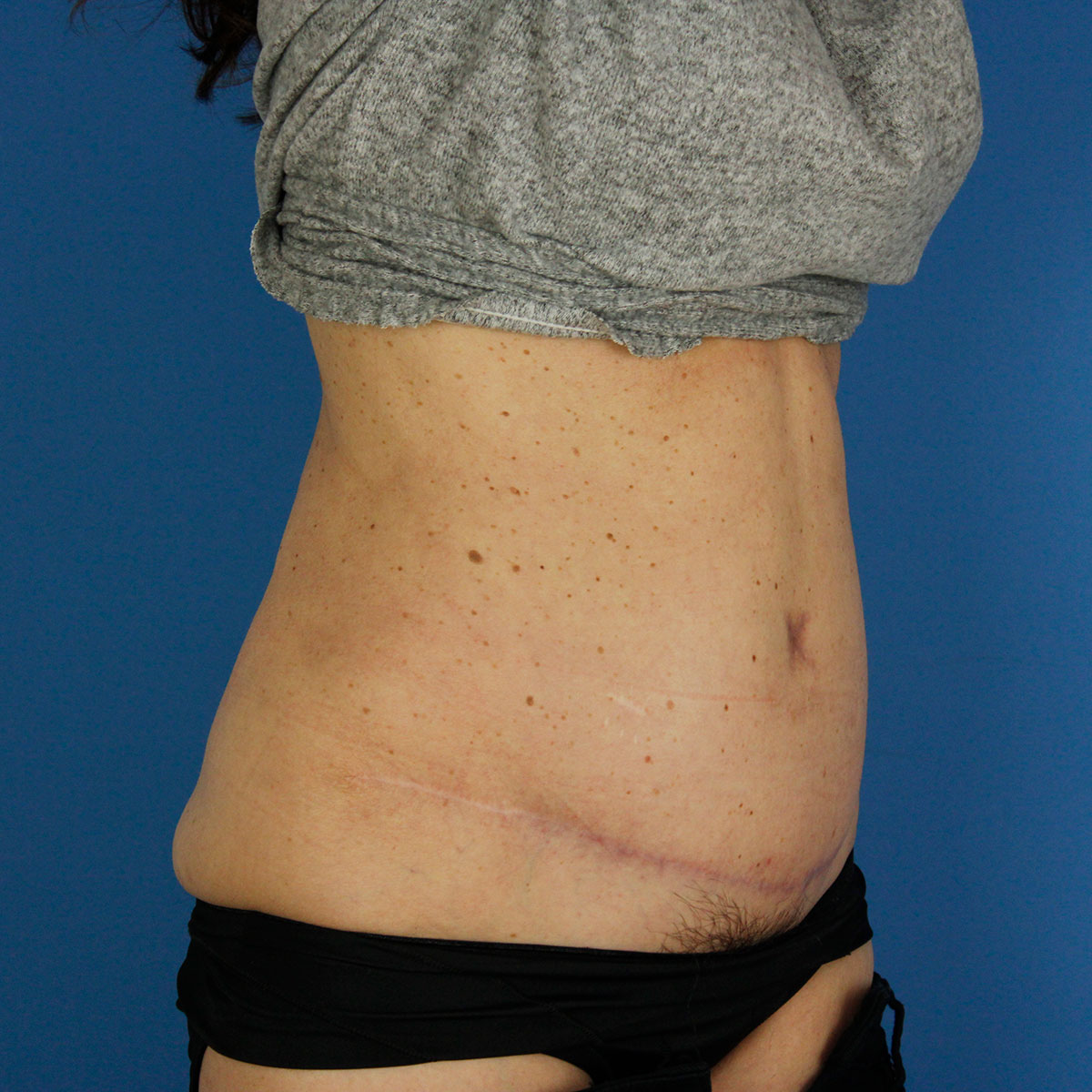 Abdominoplastia, resultado tras la cirugía — caso operado por el Dr. Gustavo Sordo en Madrid (5)