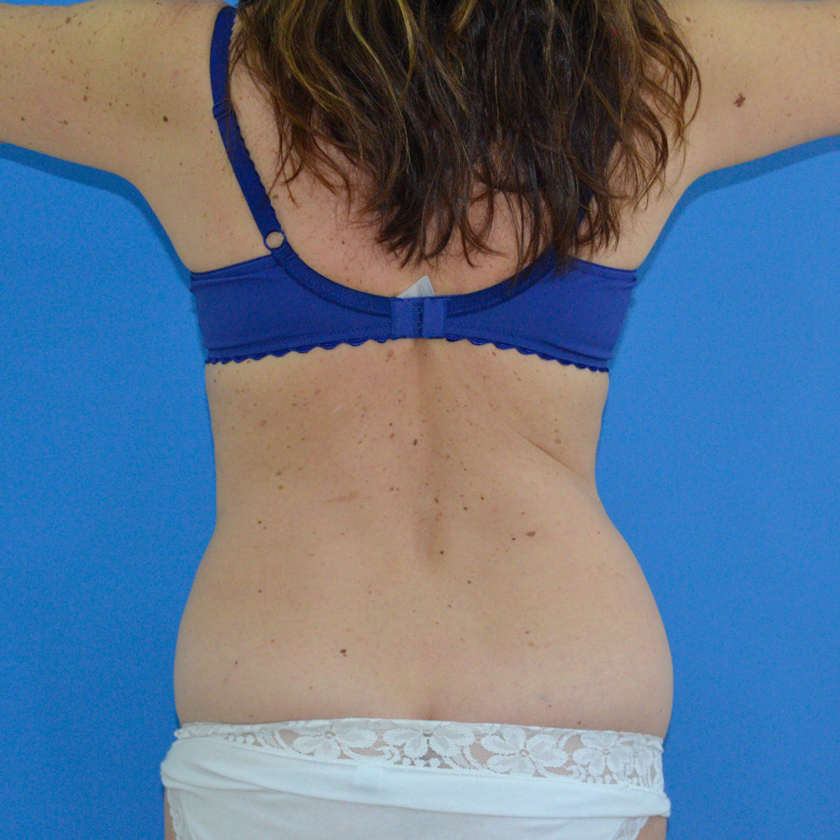 Abdominoplastia, antes de la cirugía — caso operado por el Dr. Gustavo Sordo en Madrid (6)