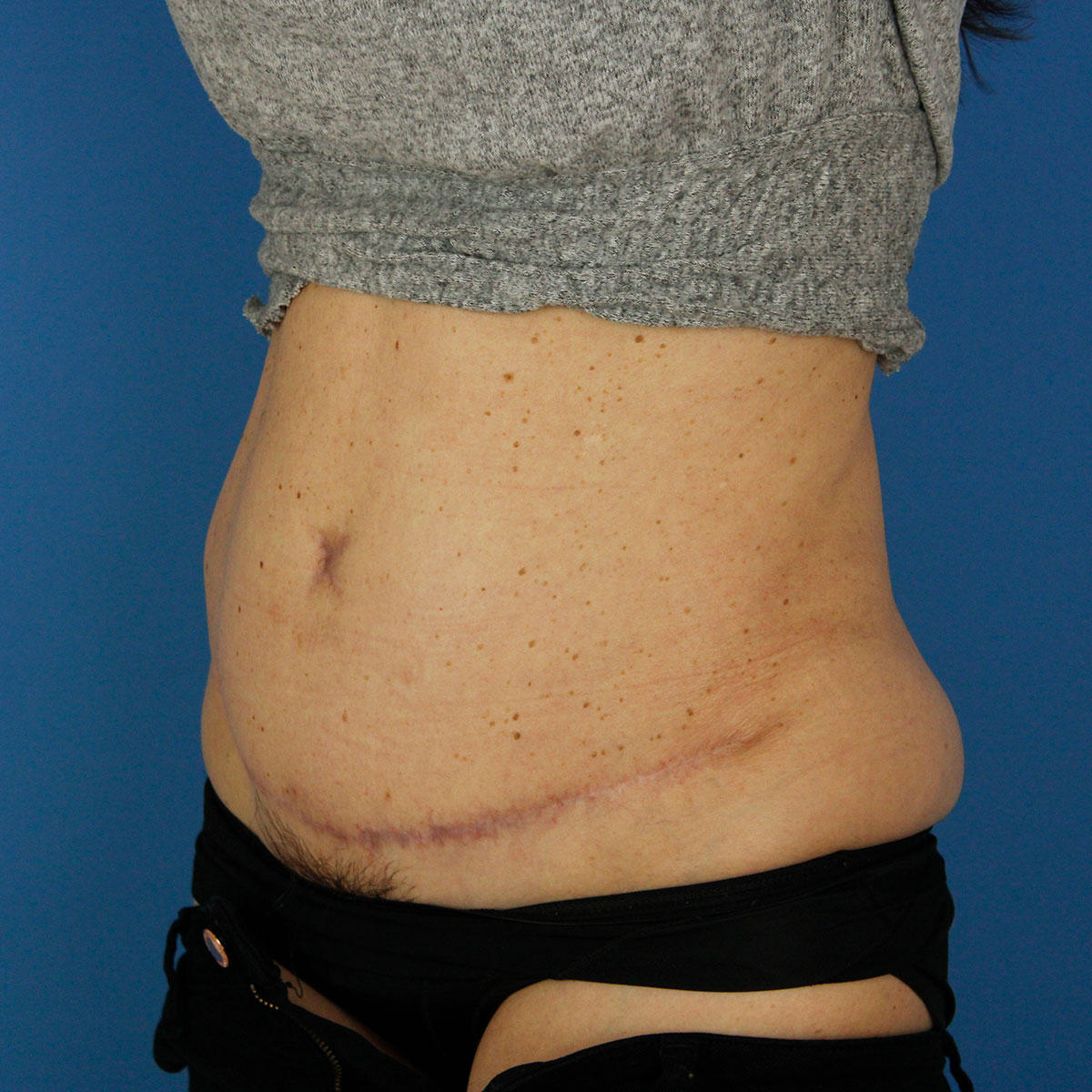 Abdominoplastia, resultado tras la cirugía — caso operado por el Dr. Gustavo Sordo en Madrid (8)