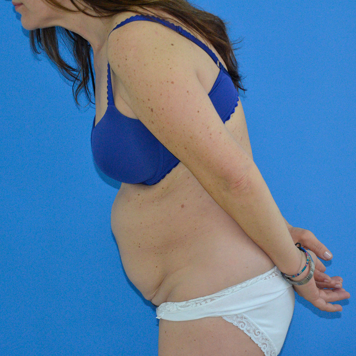 Abdominoplastia, antes de la cirugía — caso operado por el Dr. Gustavo Sordo en Madrid (9)