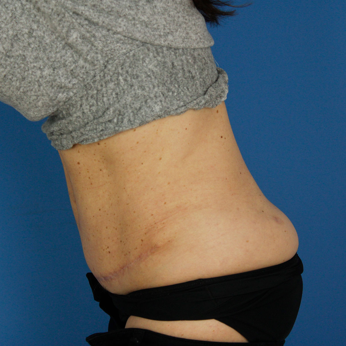 Abdominoplastia, resultado tras la cirugía — caso operado por el Dr. Gustavo Sordo en Madrid (9)