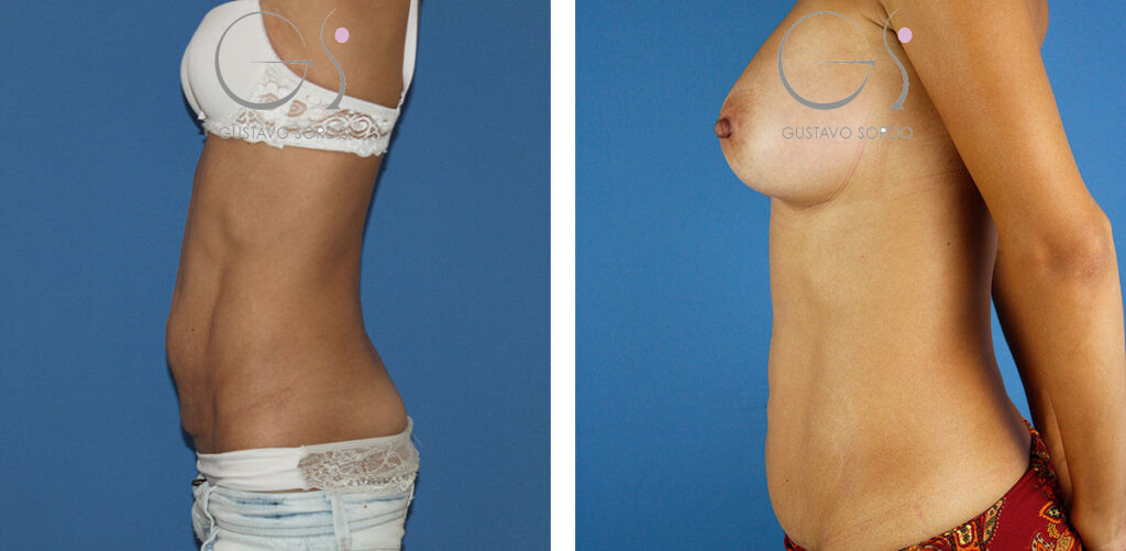 Eliminar la flacidez de la barriga a través del lifting abdominal — Dr. Gustavo Sordo, cirujano plástico en Madrid (1)