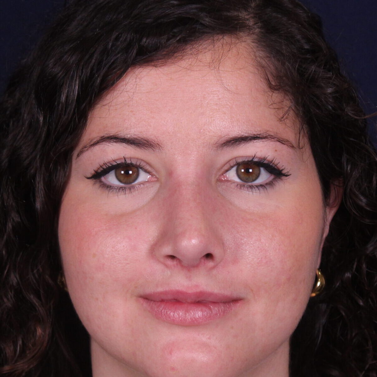 Rinoplastia estructural con giba dorsal y rotación de punta, después de la operación (1)