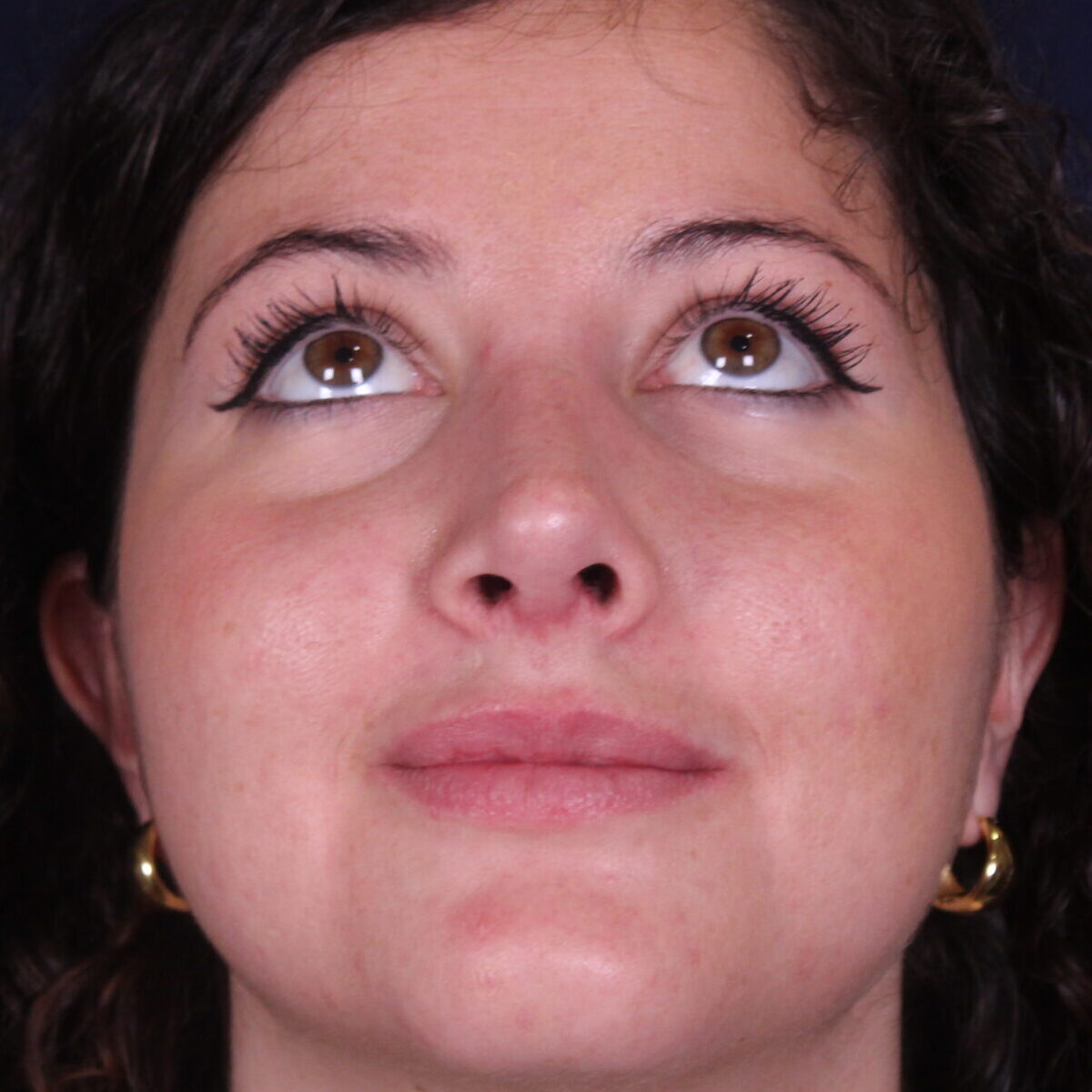 Rinoplastia estructural con giba dorsal y rotación de punta, después de la operación (3)