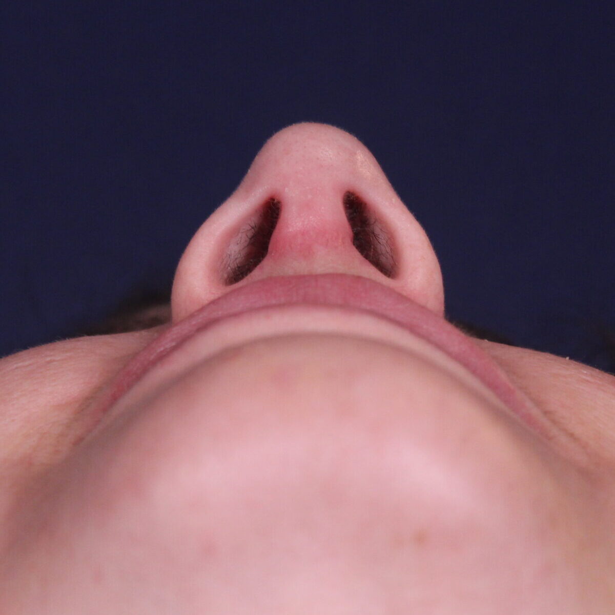 Rinoplastia estructural con giba dorsal y rotación de punta, después de la operación (4)