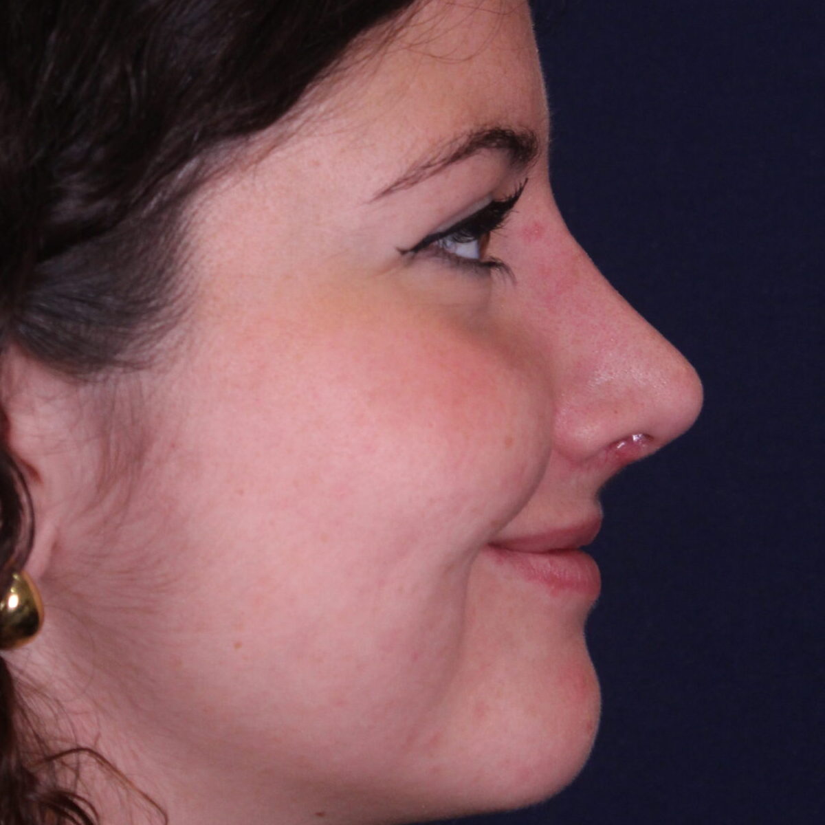 Rinoplastia estructural con giba dorsal y rotación de punta, después de la operación (5)
