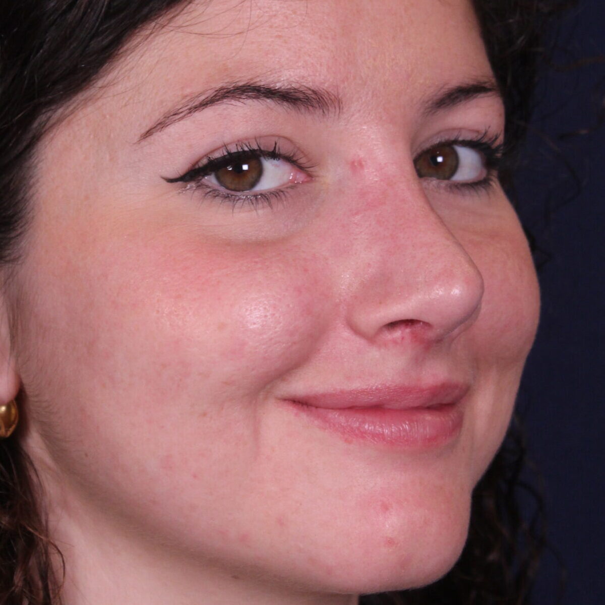 Rinoplastia estructural con giba dorsal y rotación de punta, después de la operación (7)