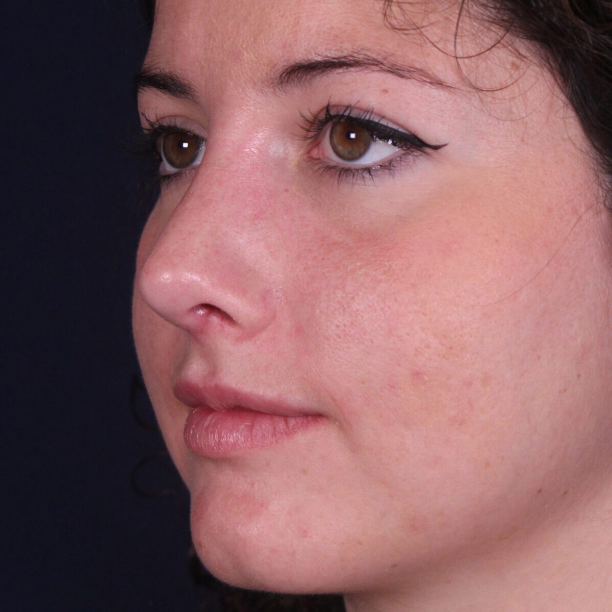 Rinoplastia estructural con giba dorsal y rotación de punta, después de la operación (6)