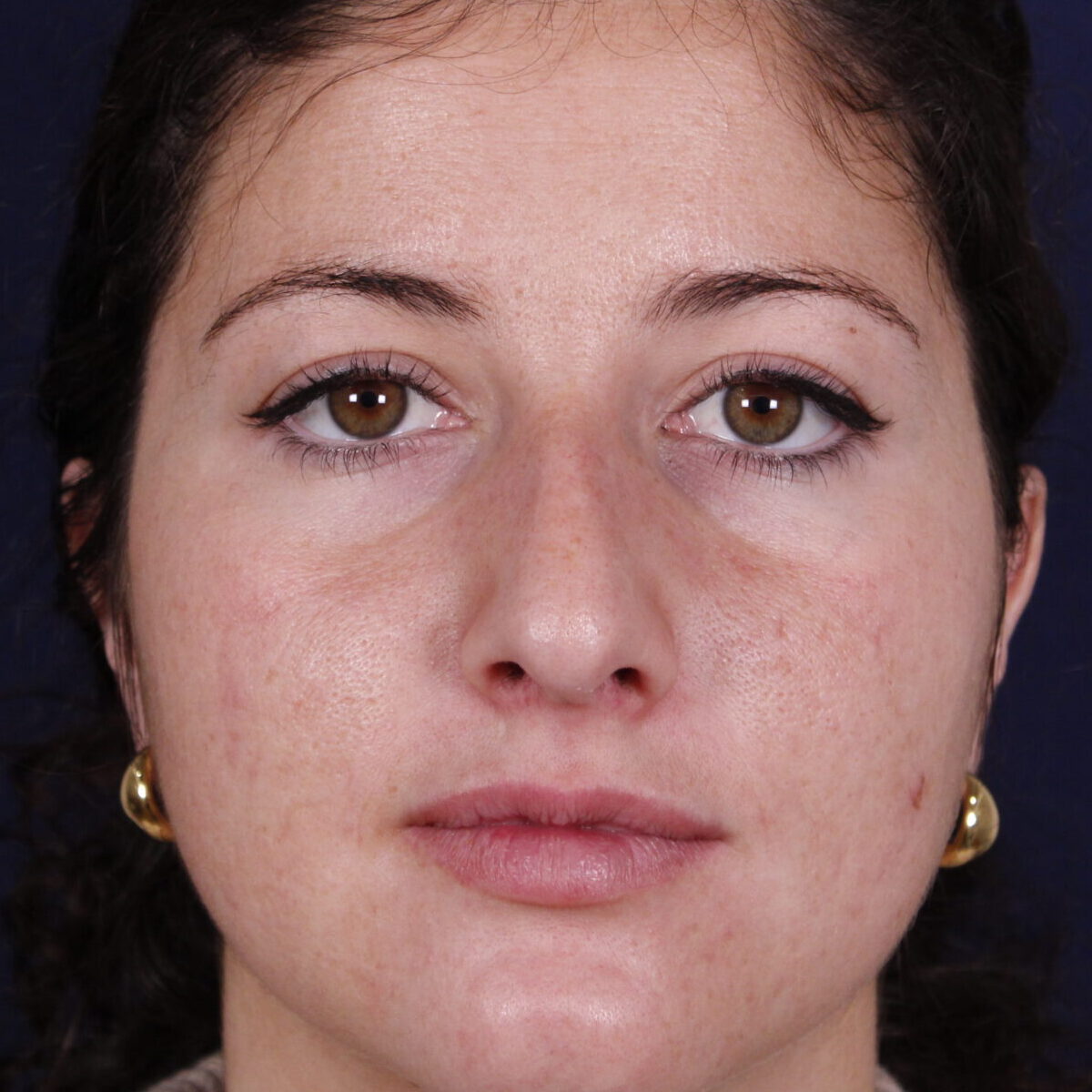 Rinoplastia estructural con giba dorsal y rotación de punta, antes de la operación (1)