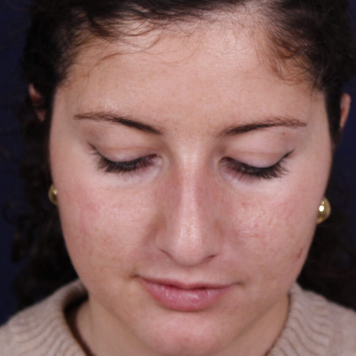 Rinoplastia estructural con giba dorsal y rotación de punta, antes de la operación (2)