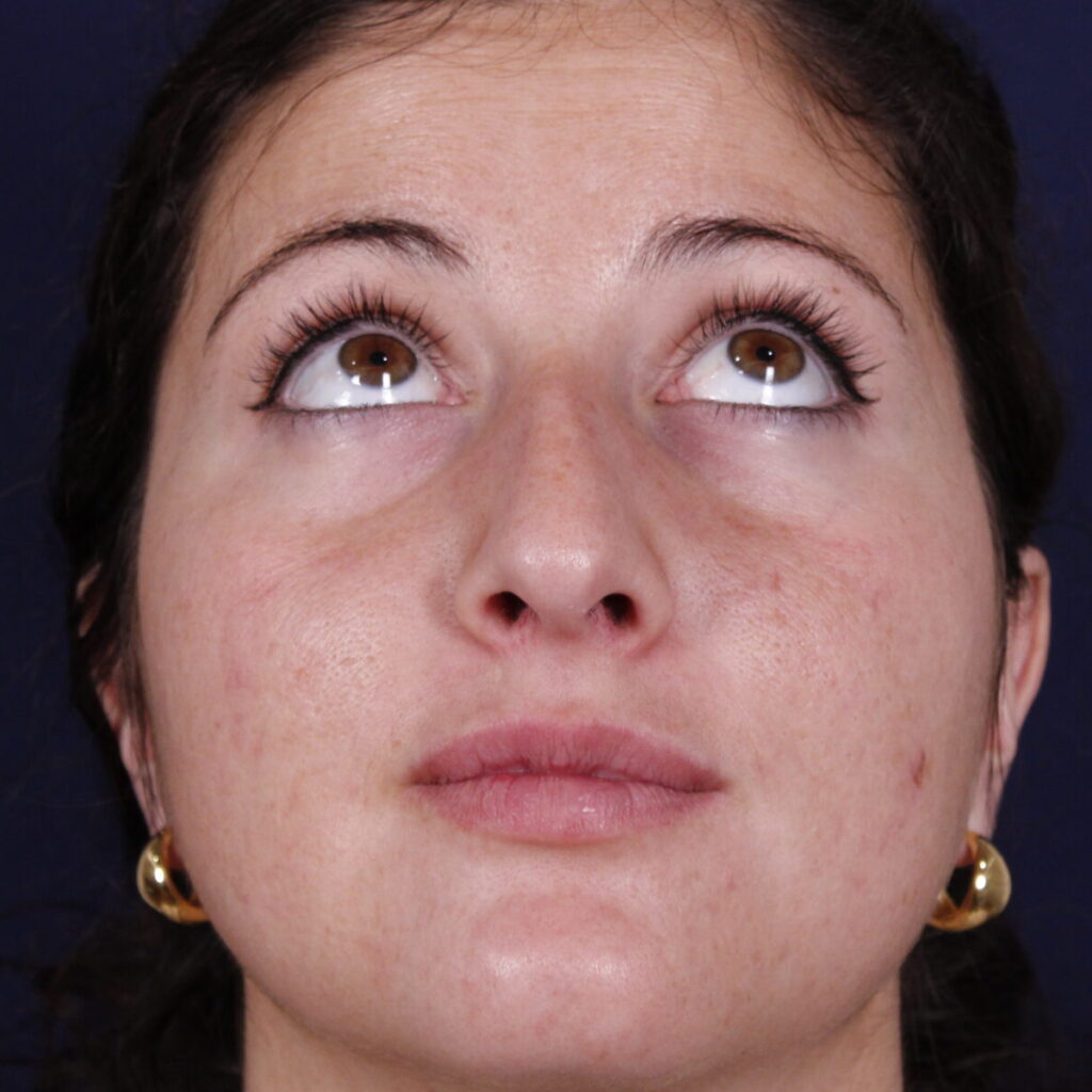 Rinoplastia estructural con giba dorsal y rotación de punta, antes de la operación (3)