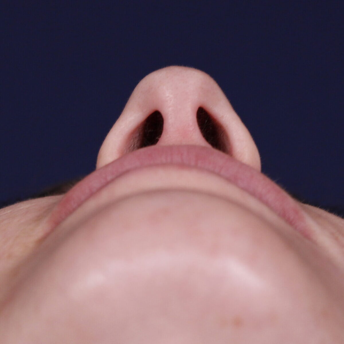 Rinoplastia estructural con giba dorsal y rotación de punta, antes de la operación (4)