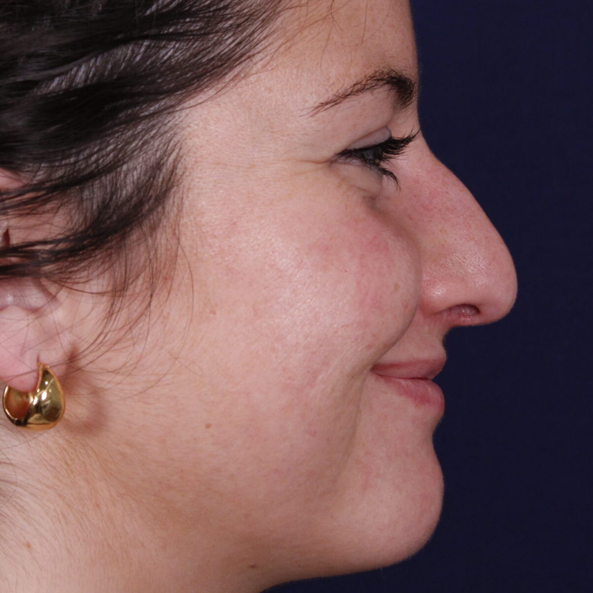 Rinoplastia estructural con giba dorsal y rotación de punta, antes de la operación (5)