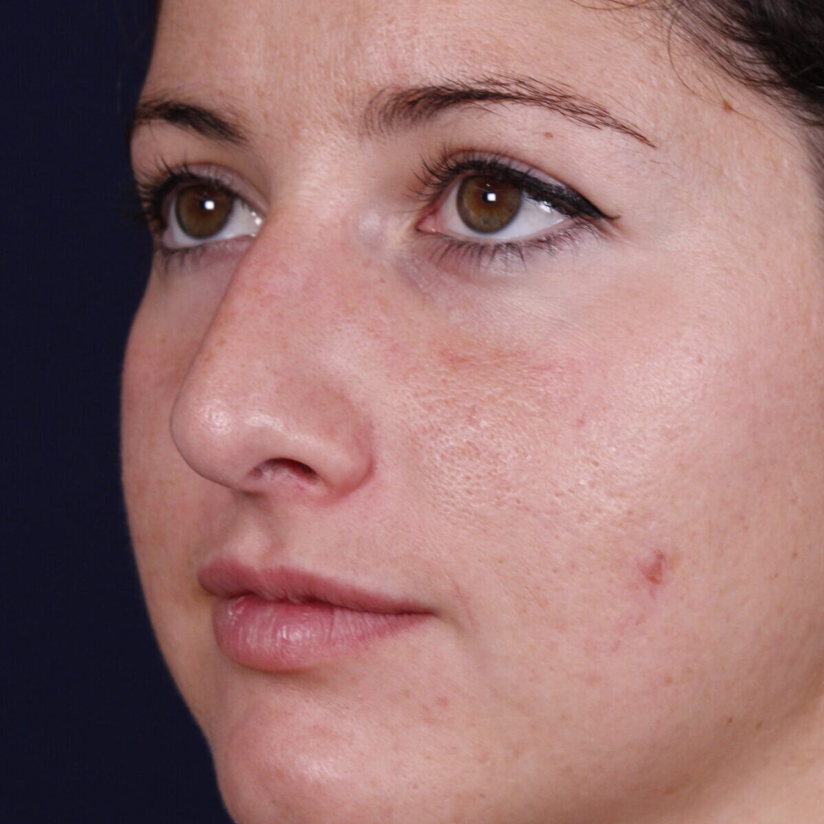 Rinoplastia estructural con giba dorsal y rotación de punta, antes de la operación (6)