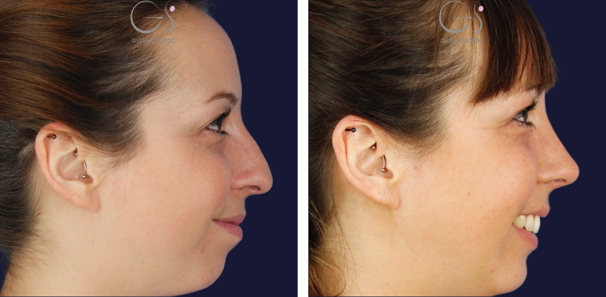 Resultado de rinoplastia híbrida, antes y después