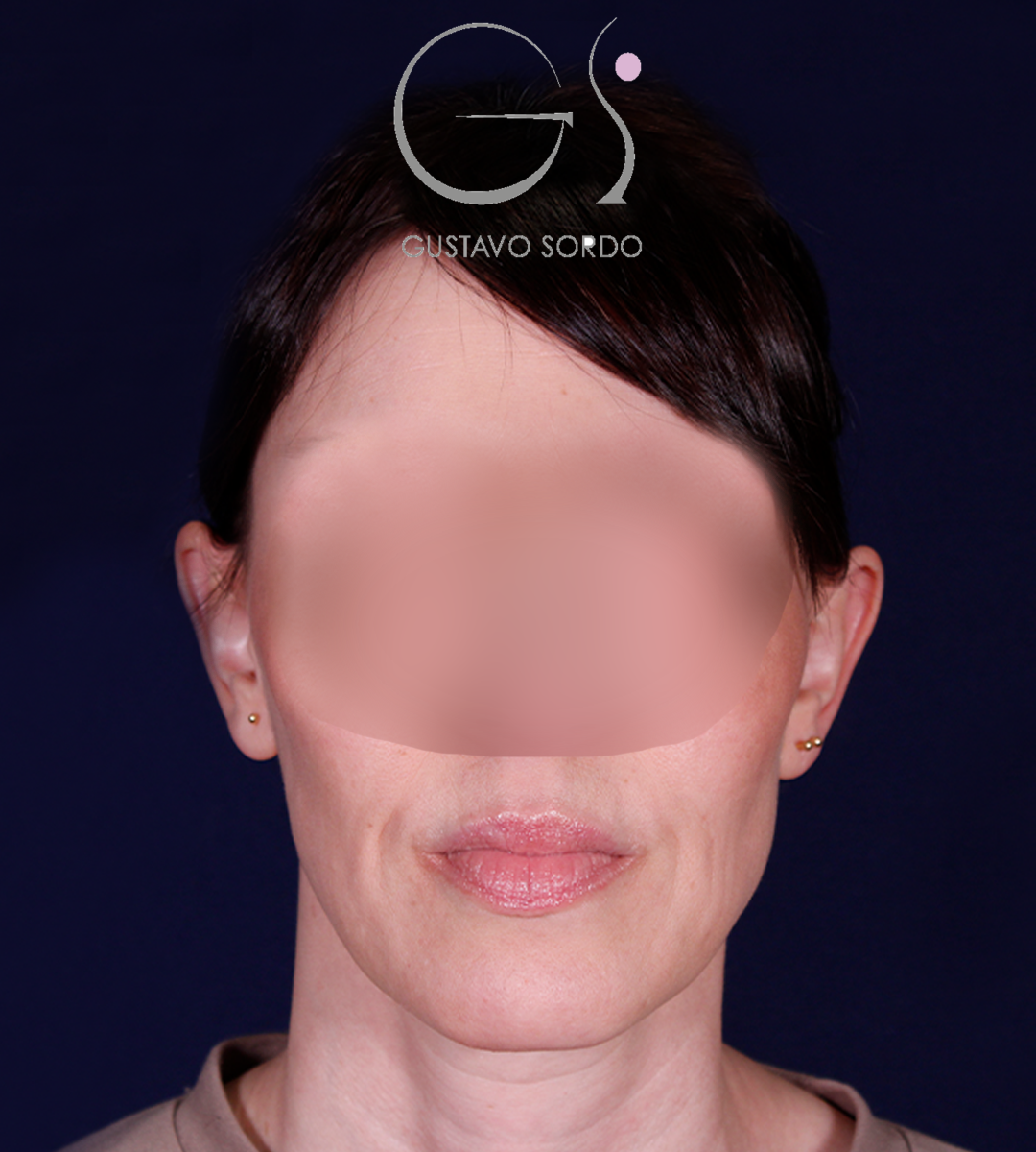 Otoplastia, antes de la operación (1)
