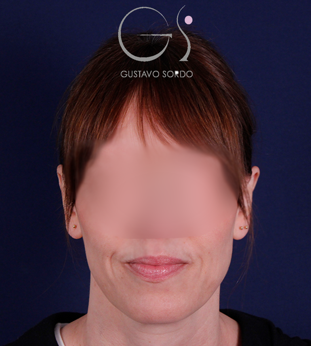 Otoplastia, después de la operación (1)