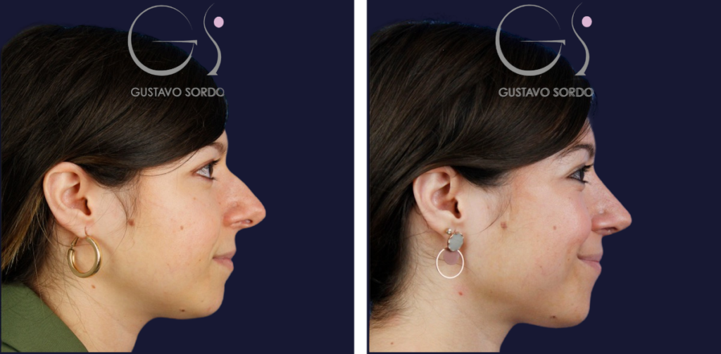 Rinoplastia: antes y después de un caso operado en Madrid