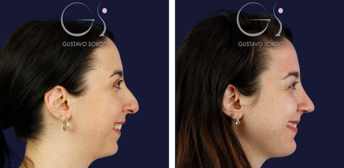 Rinoplastia: antes y después de un caso operado en Madrid