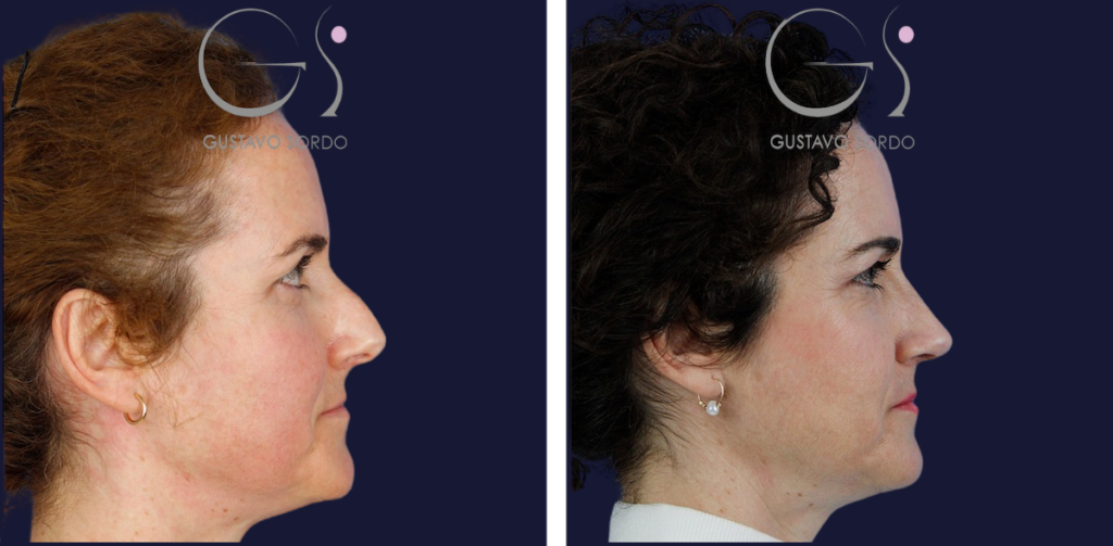 Rhinoplastie — technique ultrasonique&nbsp;: avant et après une intervention réalisée à Madrid