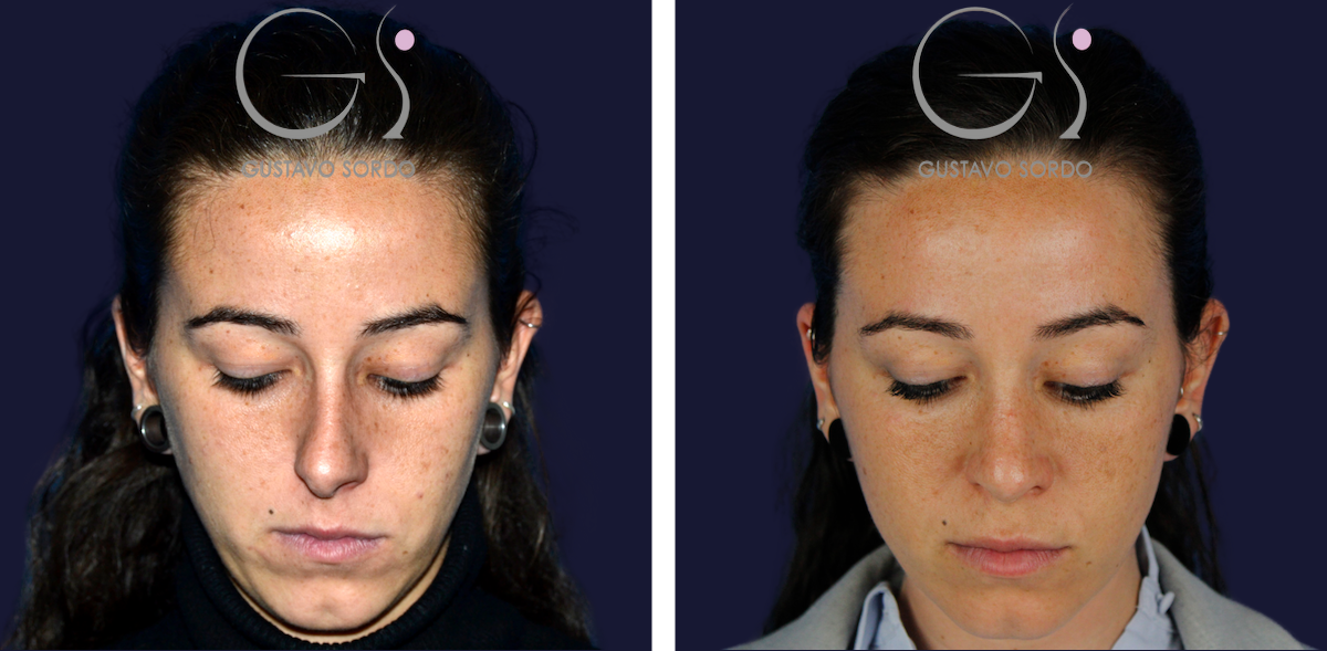 Rinoplastia: antes y después de un caso operado por el Dr. Gustavo Sordo en Madrid