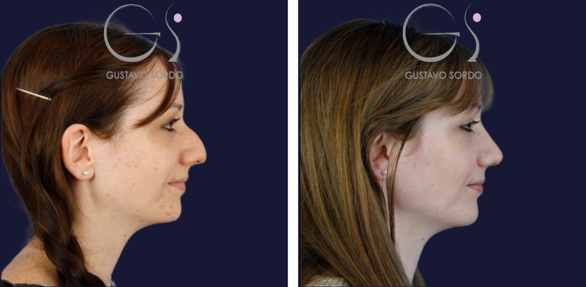 Rinoplastia en caballete en S y piel sebácea: antes y después