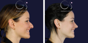 Rinoplastia — técnica ultrasónica: antes y después de un caso operado en Madrid